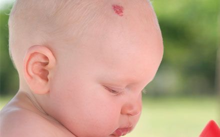Birthmarks and Recurrent Physical Problems